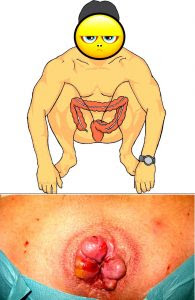 wasir ambeien hemorrhoida ambeyen hemoroid