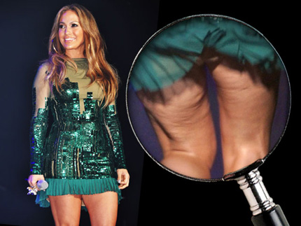 Cellulite Treatment Reviews: Jennifer Lopez Cellulite