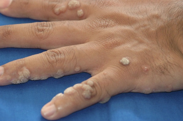 Common-Warts