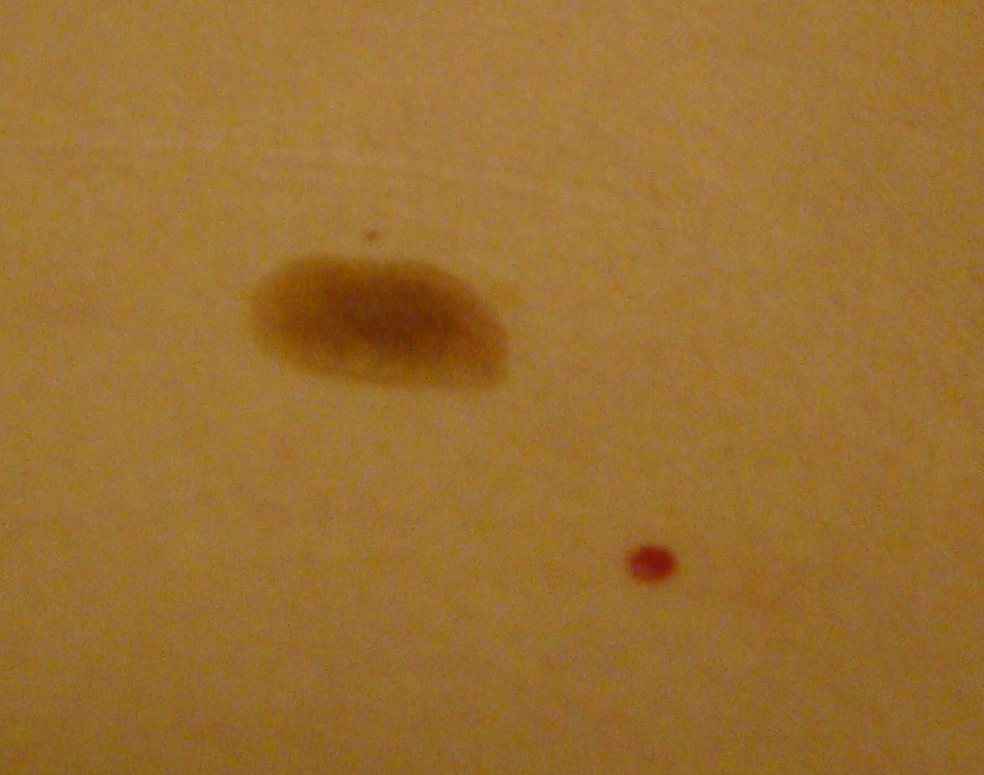 Brown Spot On My Penis 23