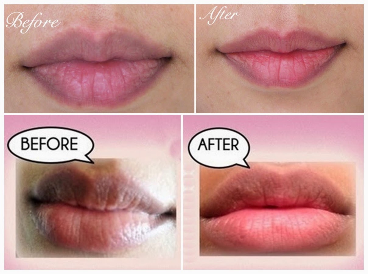 Home Remedies For Darker Upper Lips Style Hunt World