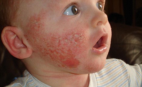 Syazni Rahim Blog: Cara hilangkan ruam di muka bayi?