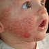 Cara hilangkan ruam di muka bayi?