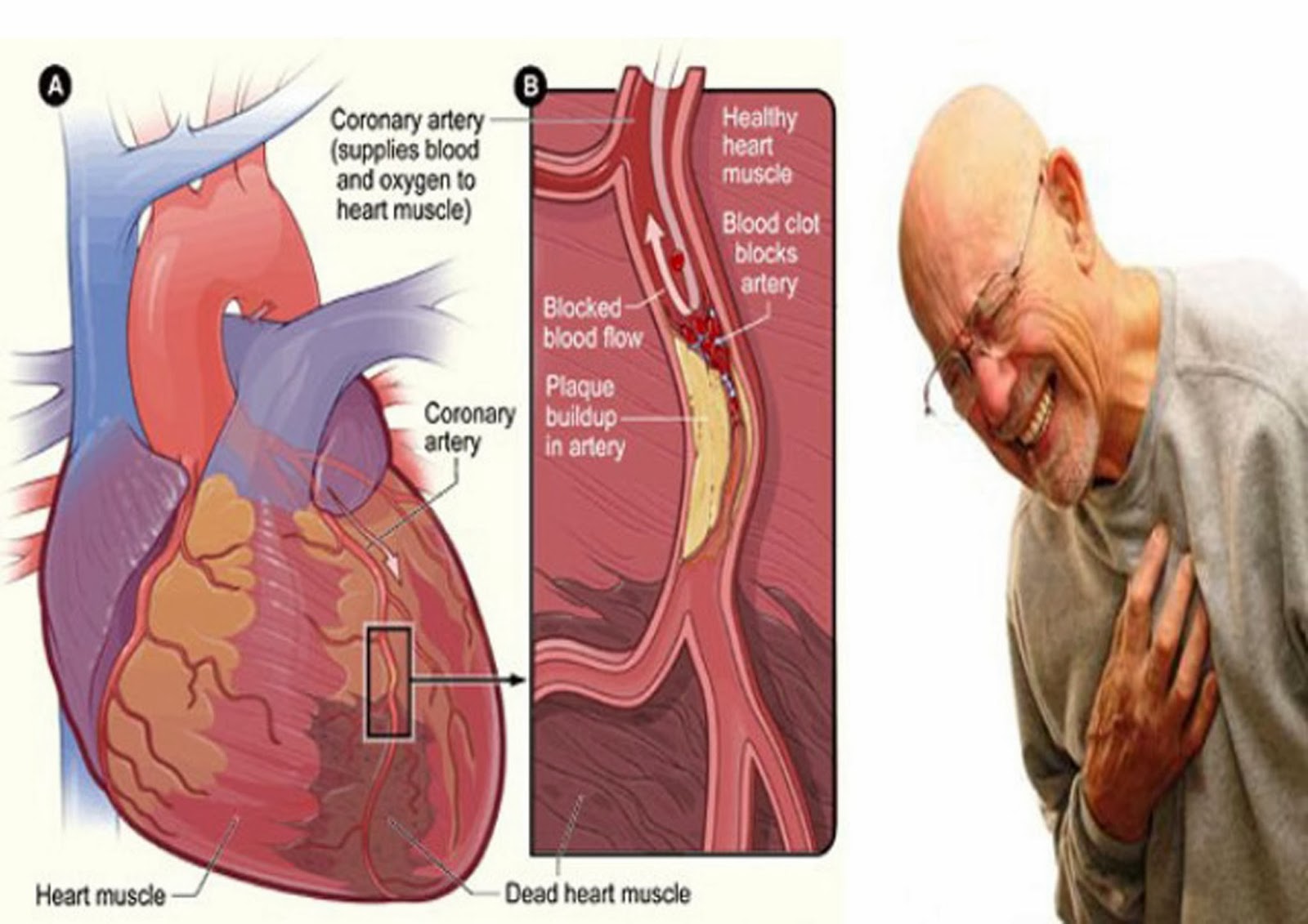 gambar gejala penyakit jantung koroner