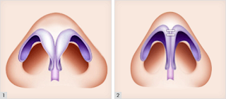 The Best Korean Rhinoplasty Surgery for Bulbous Nose The Best Korean Rhinoplasty Surgery for Bulbous Nose