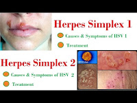 Faktor Penyebab Infeksi Herpes Genital dan Solusi yang Tepat
