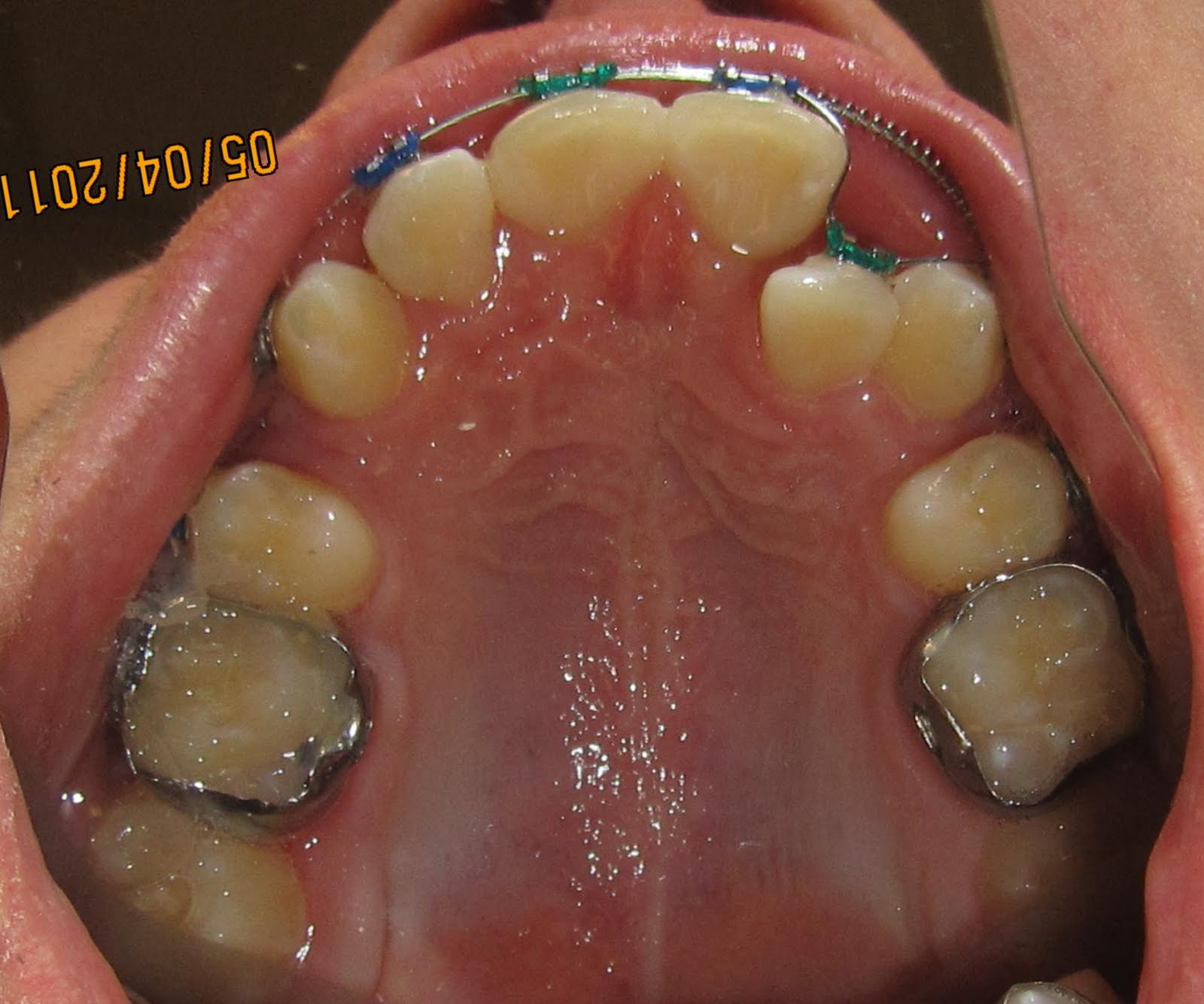 practical orthodontics Anterior labial root torque