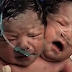 Bayi lahir dua kepala, satu badan