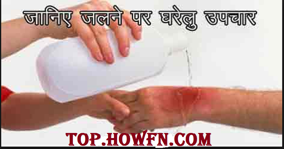 आग से जलने पर पर अपनाएं यह उपाय..Aag Se Jalne Par Kya Kare