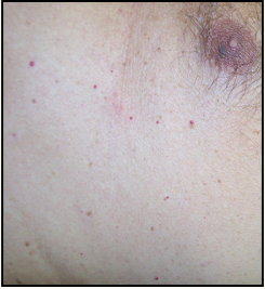 Guide To Use Cherry Angioma Removal Products That Works On Every