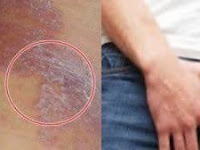 Selangkangan hitam dan gatal apakah gejala eksim Selangkangan hitam dan gatal apakah gejala eksim