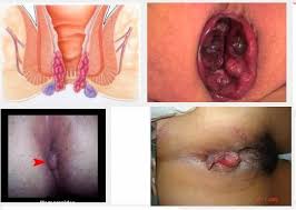 Foto JUAL OBAT TRADISIONAL UNTUK BAB BAYI BERLENDIR