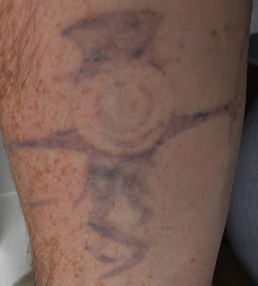 Laser Tattoo Removal One week after Picosure Tattoo Removal