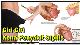 Obat Paling Ampuh Untuk Sembuhkan Sipilis Tidak Kunjung Sembuh Sudah Parah