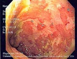 spondilite anchilosante e perdita di peso
