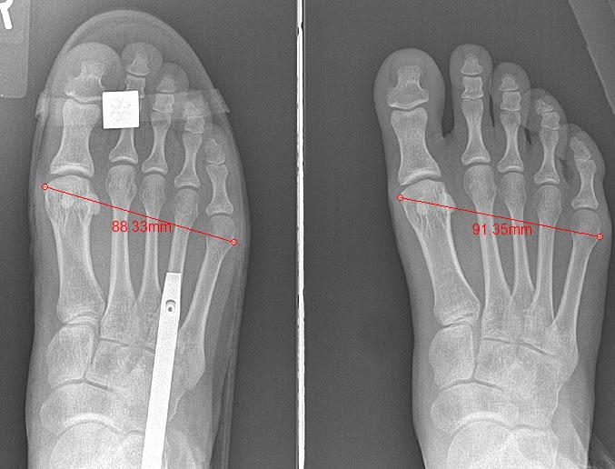 Podiatrist in Orange County Irvine, CA Sports Medicine Foot and Ankle