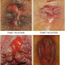 Obat Salep Untuk Benjolan Disekitar Anus thumbnail