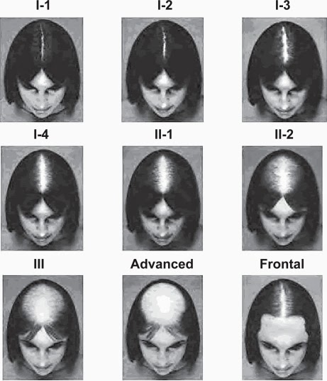 The Well Rounded Mama Pcos And Hair Loss Part 1 Prevalence And