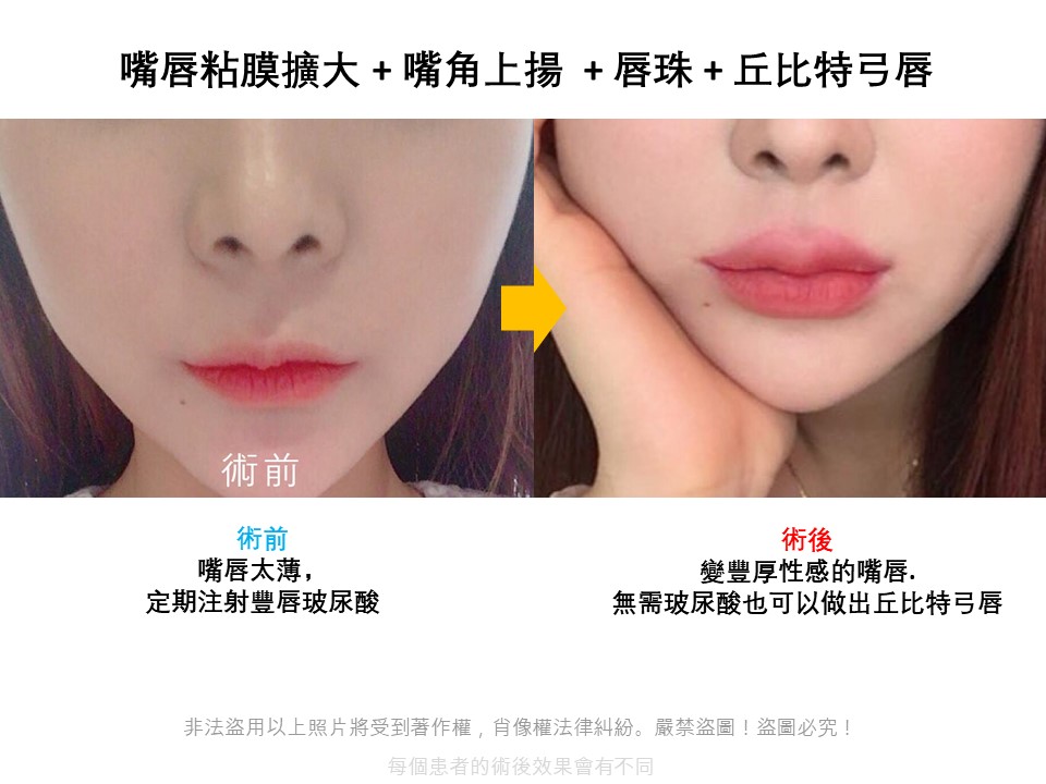 凱奇美女公主日記catch Meinv 韓國唇部整形 豐唇 嘴角上揚 M字型嘴唇手術後記