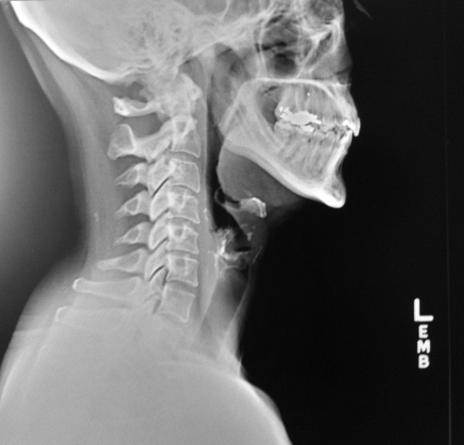 Adhesive Capsulitis Alternative Approach Radiographs for Adhesive