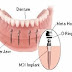 Tại sao giá trồng răng implant lại cao ?