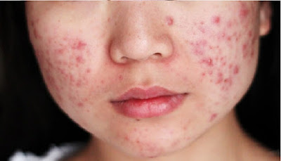 Acne Affliction in All Ages - Infant acne Acne Affliction in All Ages - Infant acne