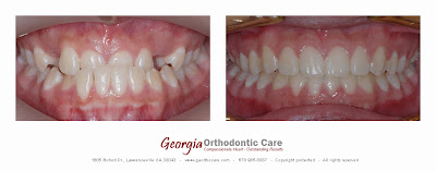 Orthodontic treatment of dental crossbite