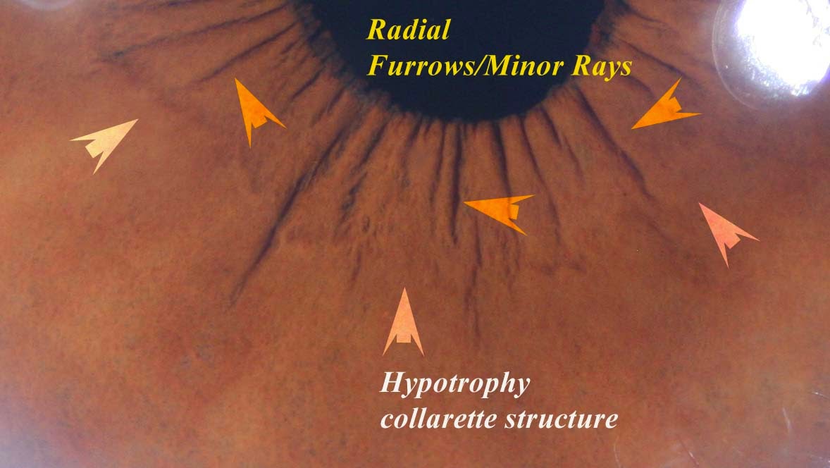 Modern & Multidimensional Iridology: Hypoplastic of the Collarette ...