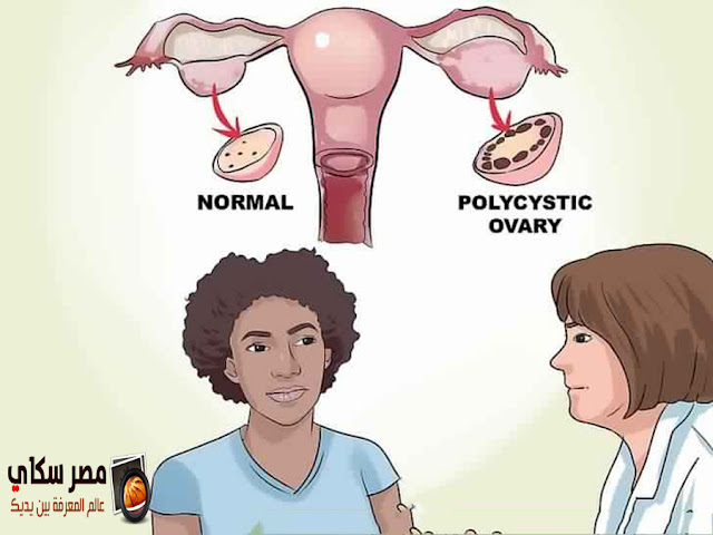 تكيس المبايض والأعراض والعلاج polycystic ovary