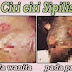 Nama Obat Sipilis Di Apotik Yang Ampuh