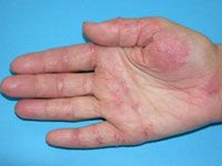 dermatitis hands #9
