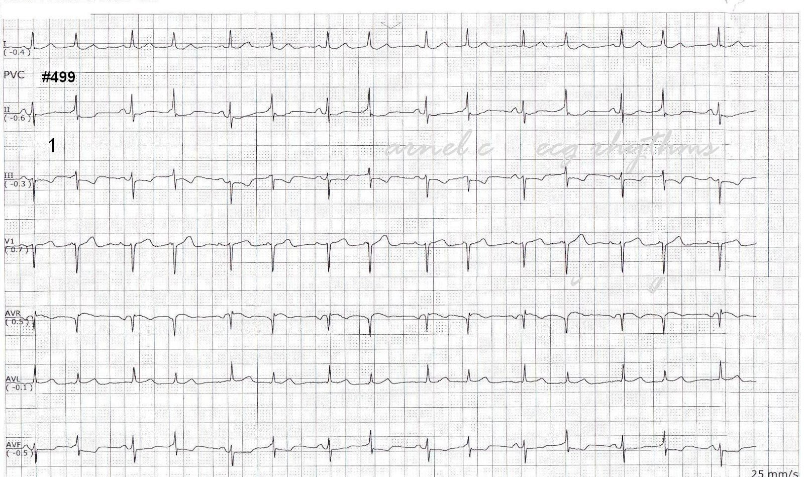 ECG Rhythms Intermittent preexcitation, QRS alternans or intermittent