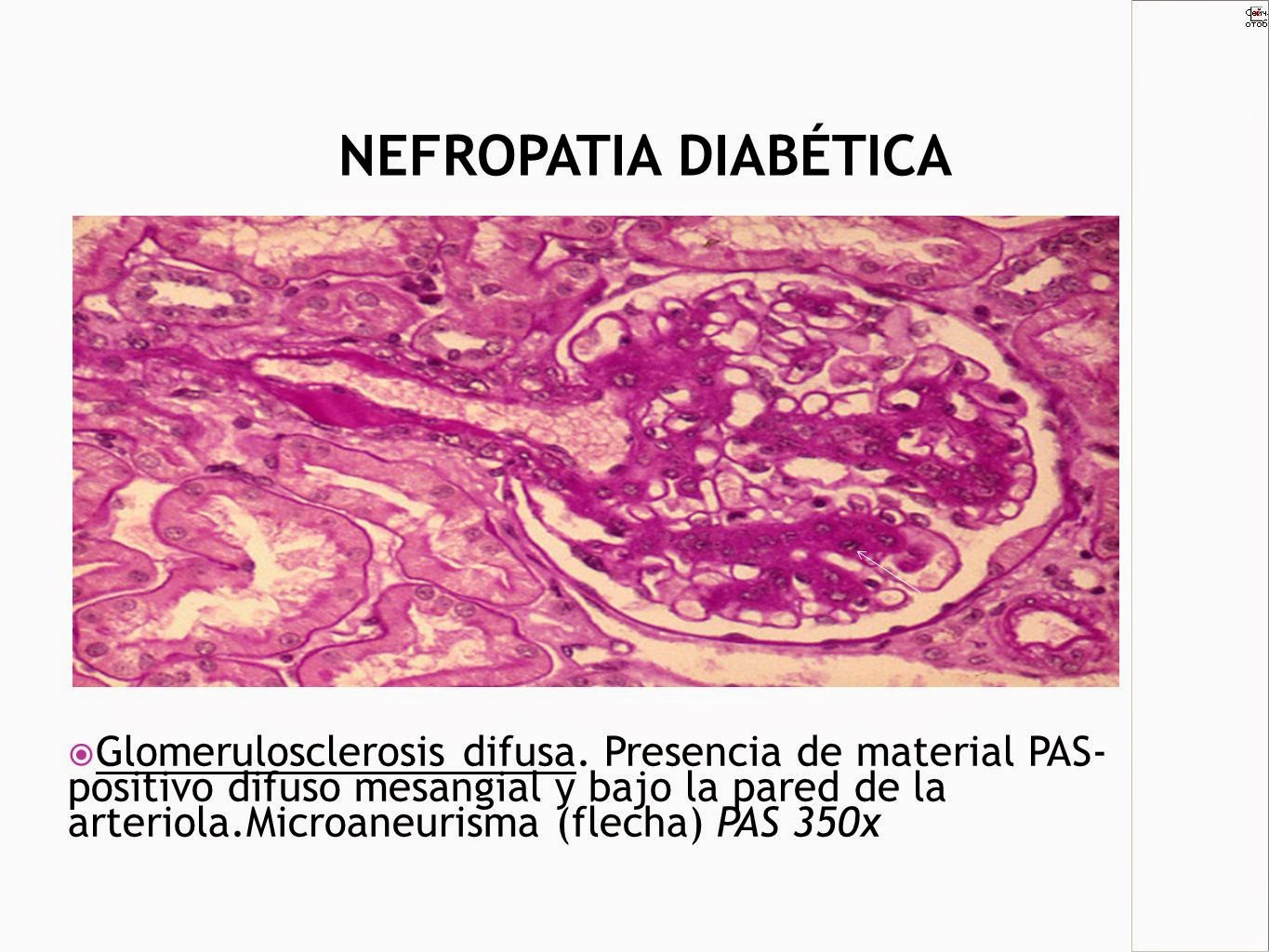 Agustina Ocampo - Patología B 2014: Diabetes Mellitus