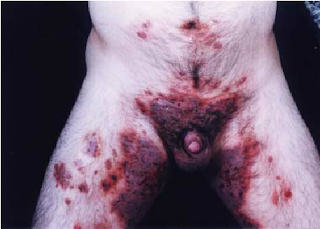 Obat Infeksi Menular Seksual Obat Infeksi Menular Seksual