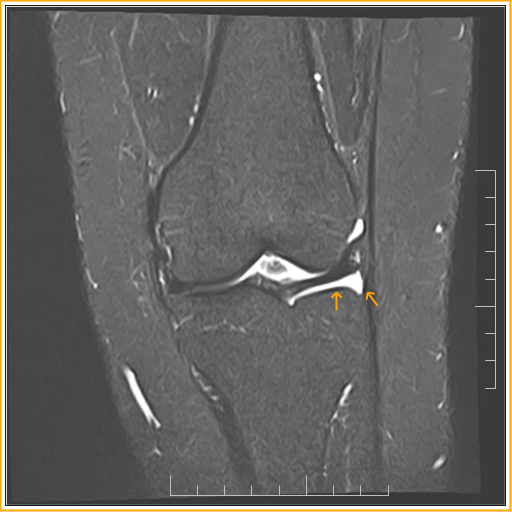Floating MeniscusMRI Radiology Imaging