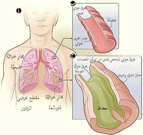 توسع القصبات أو توسع الشُّعَب