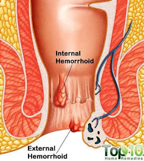 1 Natural Solution To Piles [Hemorrhoids] Discovered!