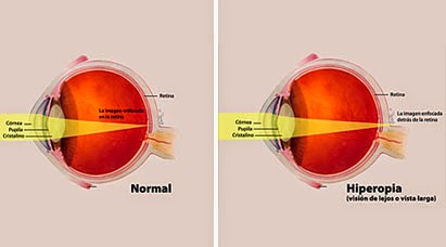 Viciile de refractie: miopia, hipermetropia si presbiopia
