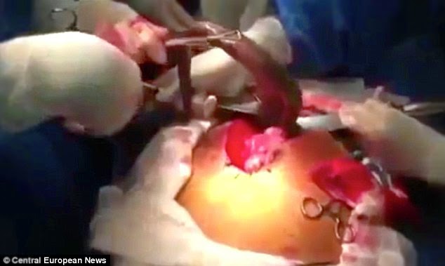 Lungfish Being Removed Inside Stomach Shown in Hospital Video Goes Viral