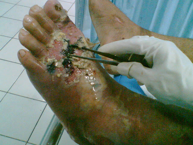 Obat Sakit Gula Darah Tinggi Basah Obat Sakit Gula Darah Tinggi Basah