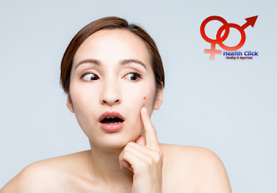 natural acne medicine, healtclick, health, healthclick, life insurance life insurance,natural acne medicine, healtclick, health, healthclick