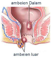 Obat Wasir dan Ambeien yang Bisa Anda Buat Tanpa Perlu ke Dokter
