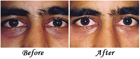 How to Treat Eczema Around the Eyes | LIVESTRONG.COM