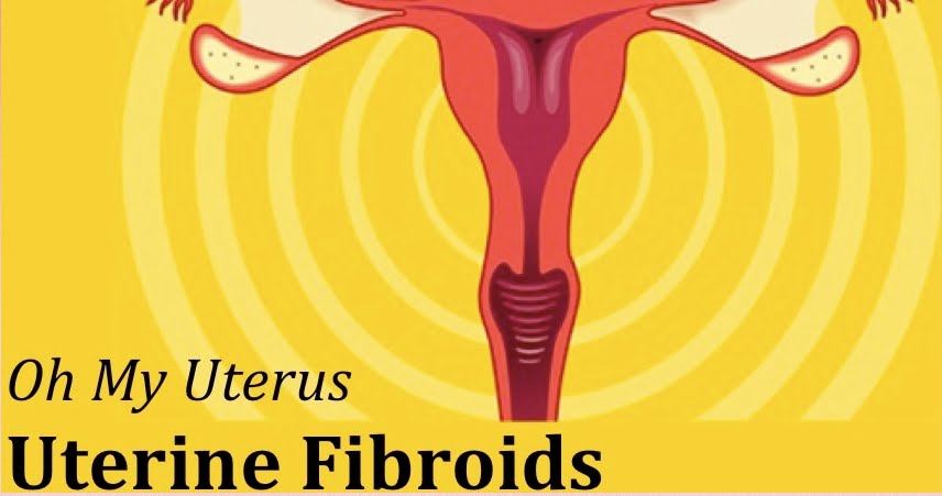 Oh My Uterus!                            Uterine Fibroids