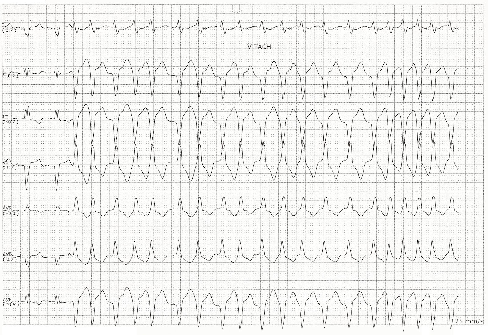 Ventricular Tachycardia Rhythm