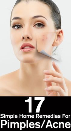 home remedies for acne dark spots