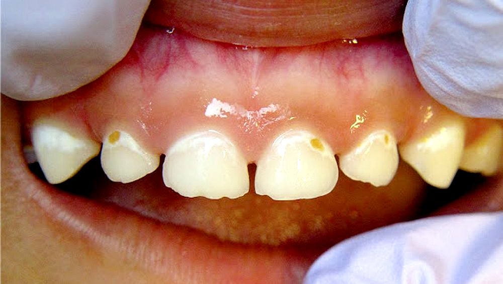 Caries de Biberón