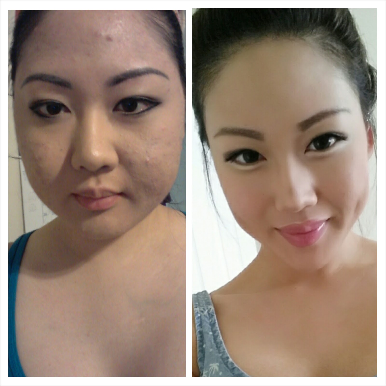 Cushing's Disease Cushing's Frequently Asked Questions (FAQs)