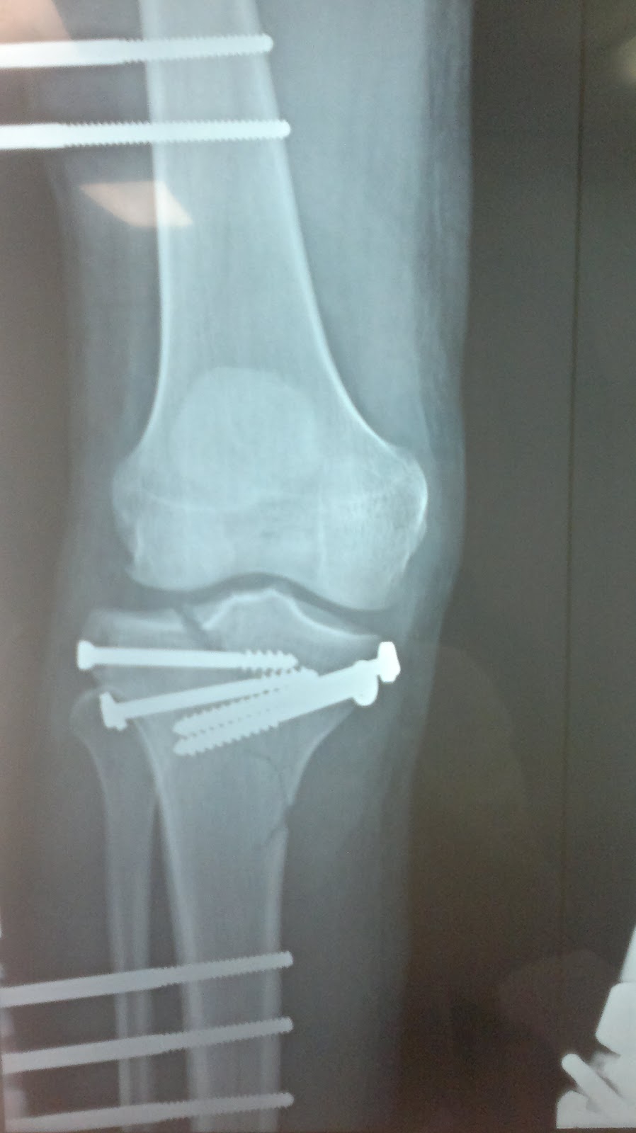 O R T O C R I T I C A Fractura de meseta tibial asociada a lesion ligamentaria O R T O C R I T I C A Fractura de meseta tibial asociada a lesion ligamentaria