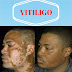 Ramuan Herbal Untuk Mengobati Vitiligo Sampai Sembuh Total